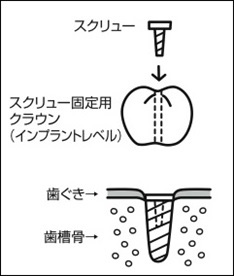 1) インプラント・レベルの上部構造