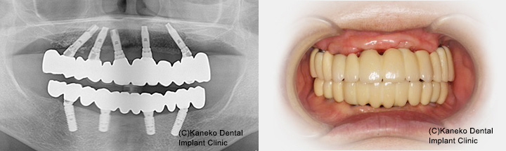 使用するインプラントシステムと歯科医の技術について