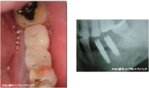 症例1　下顎前歯部症例