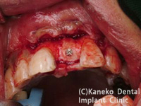 前歯部のインプラント症例1（抜歯即時インプラント埋入）