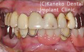 症例3　上顎中切歯、側切歯欠損の症例