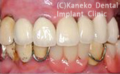 症例3　上顎中切歯、側切歯欠損の症例